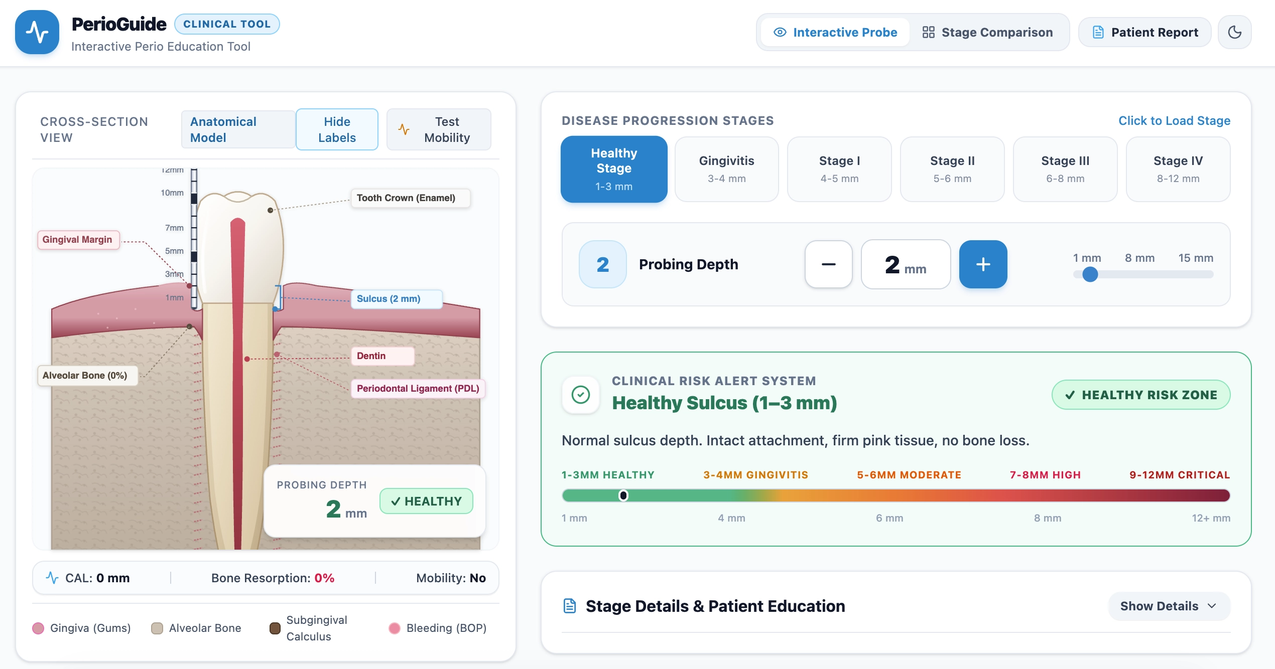PerioGuide interactive perio education tool showing a tooth cross-section with a probe, disease progression stages and a clinical risk alert system